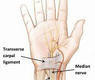 What Is Carpal Tunnel Syndrome?